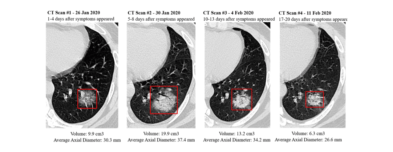 Computer Vision ct-scan