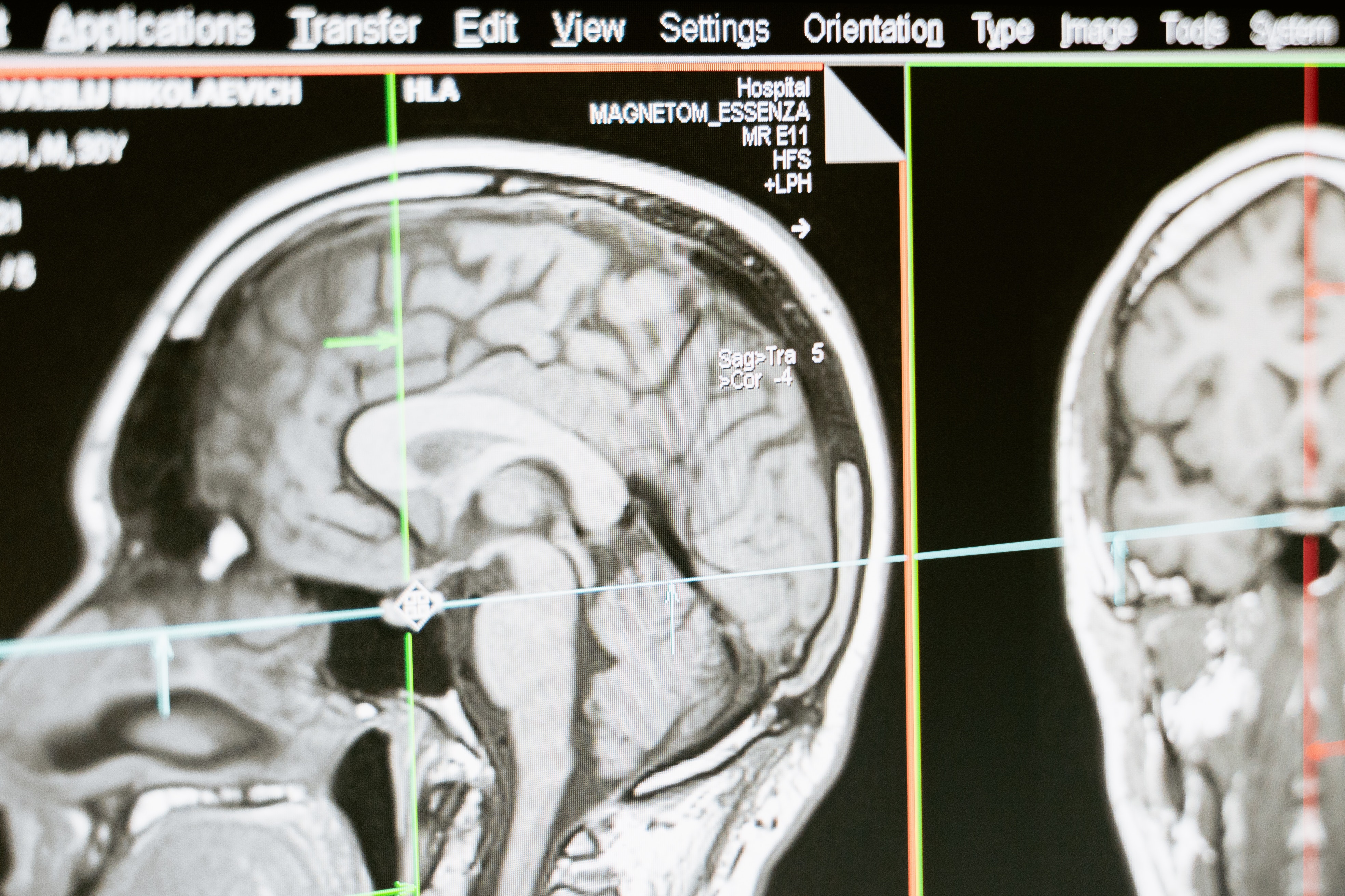 Brain tumor detection image