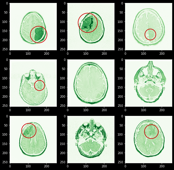 tumor detection | MRI