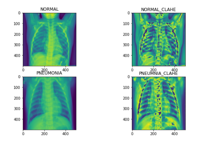 Pretrained-Stacked Model | X-rays 
