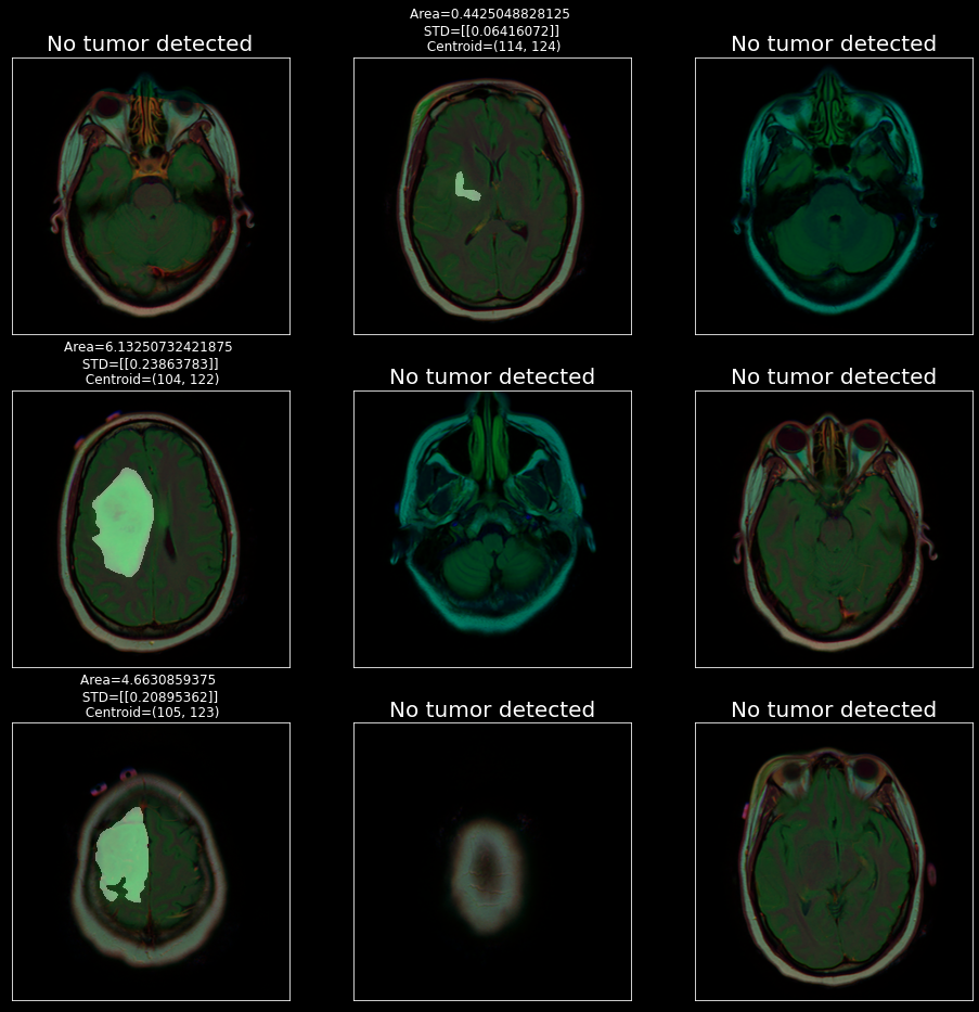 MRI