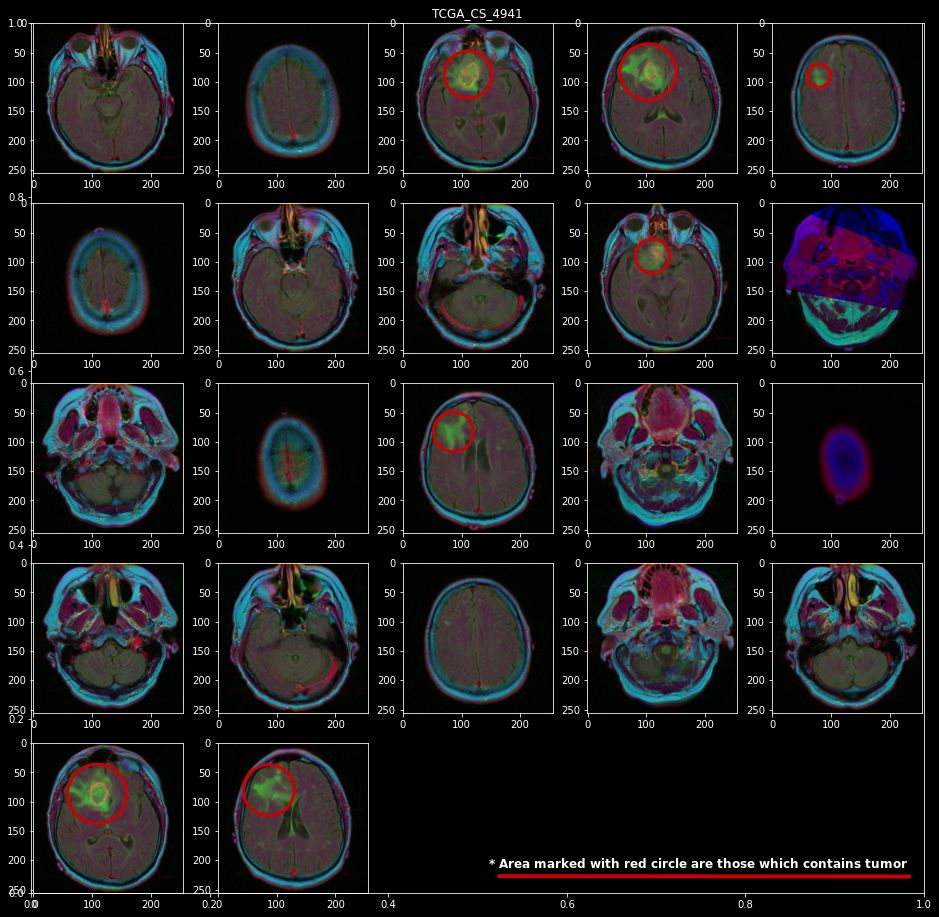 data preprocessing | MRI