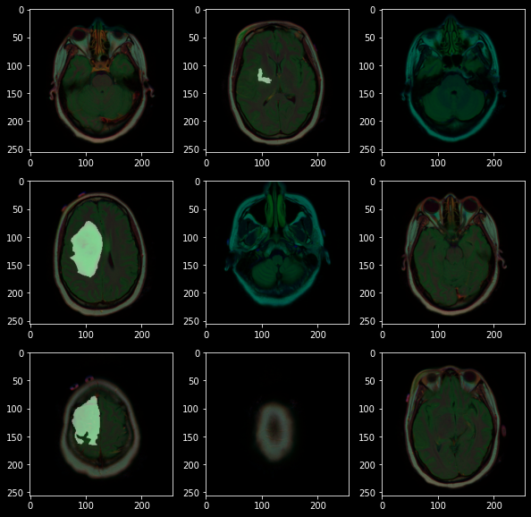 MRI